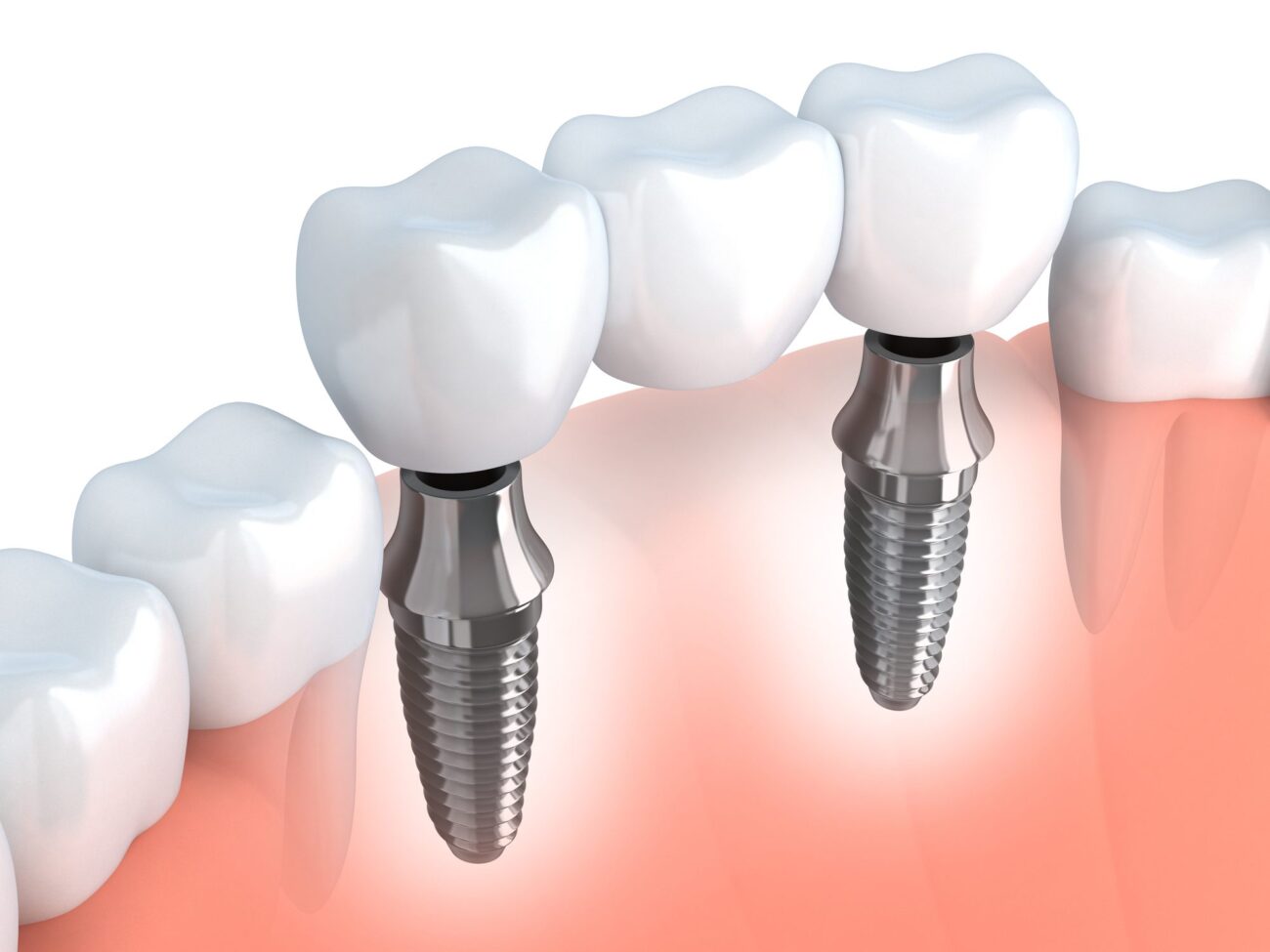Average Cost Of Dental Implants In Morristown Nj Dr Gittleman